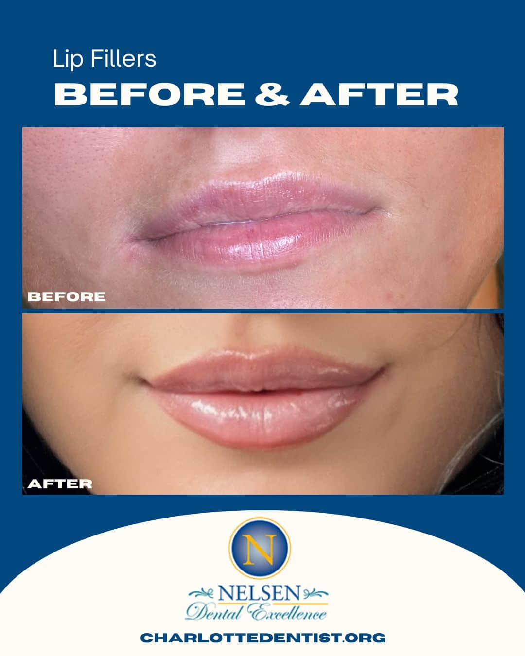 lip fillers charlotte dentist