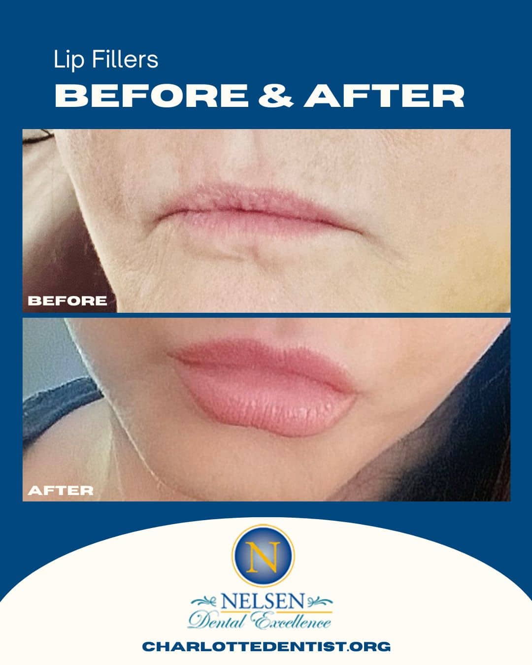 lip fillers charlotte dentist