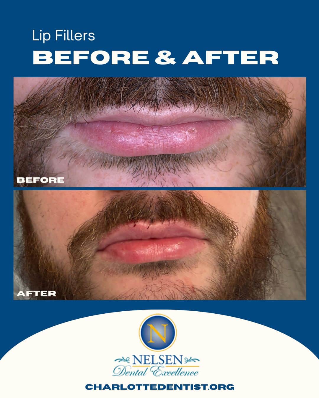 lip fillers charlotte dentist