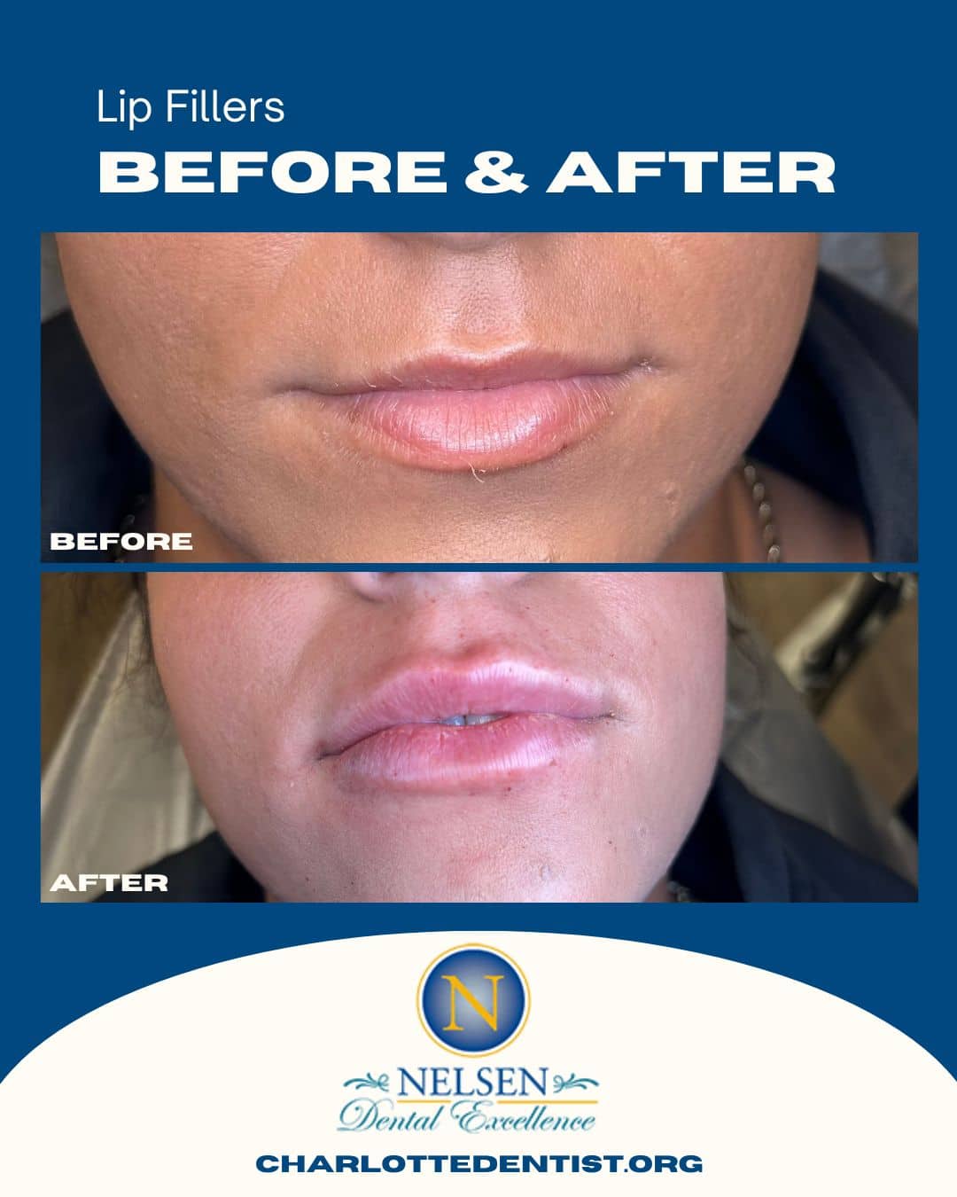 lip fillers charlotte dentist