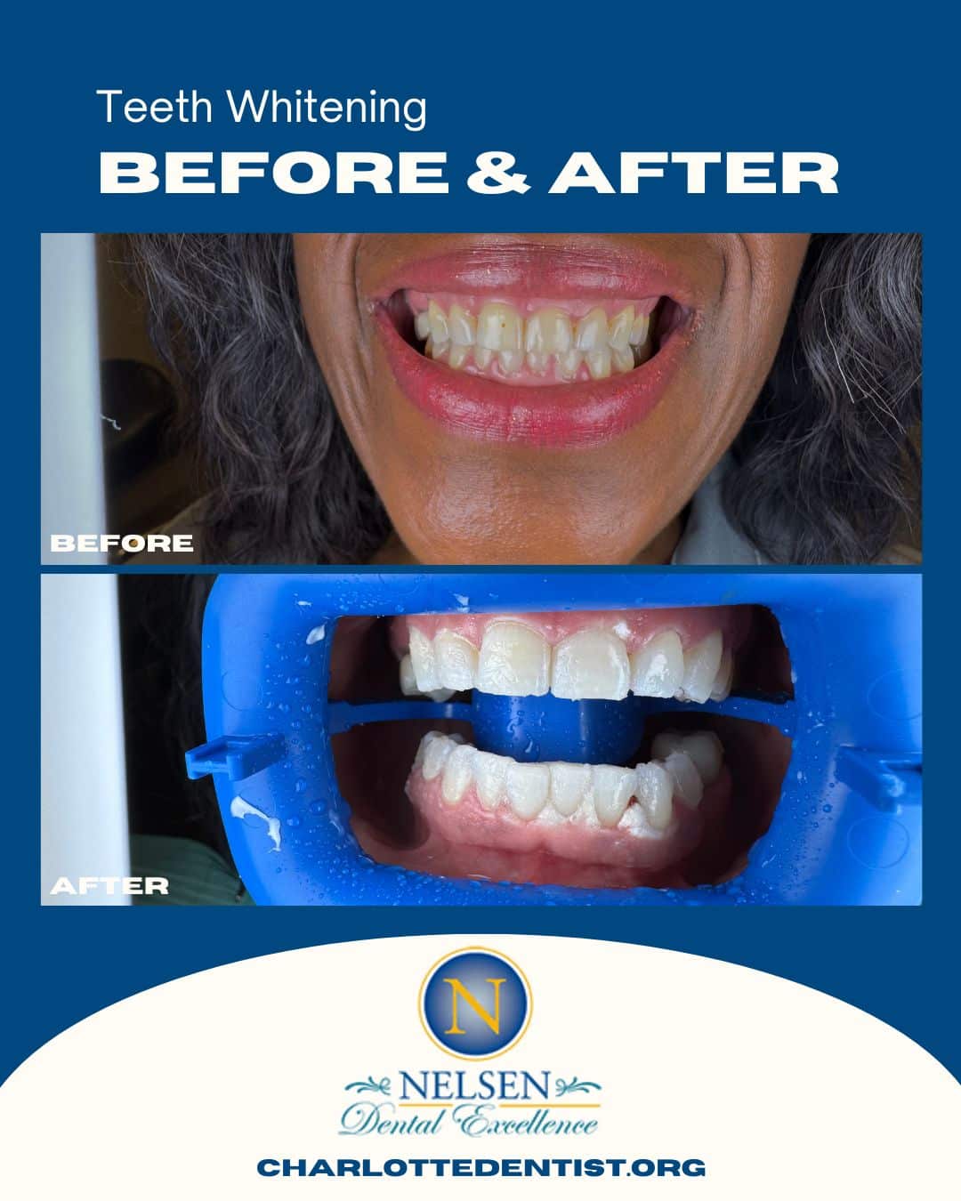teeth whitening charlotte dentist