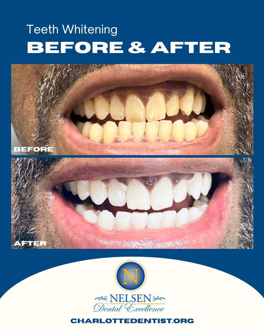 teeth whitening charlotte dentist