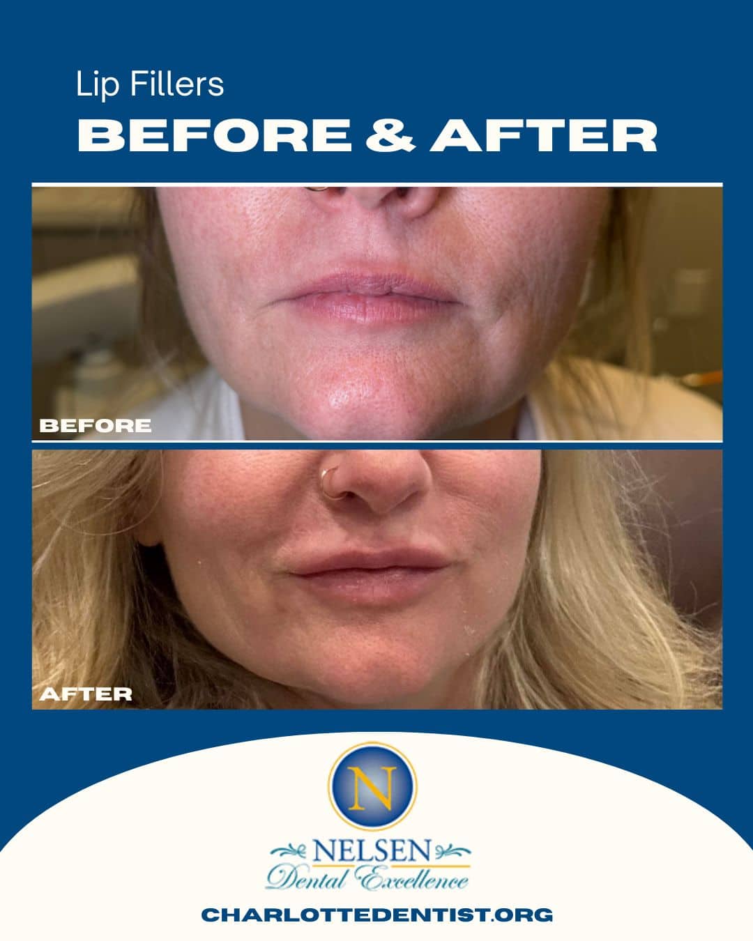 lip fillers charlotte dentist