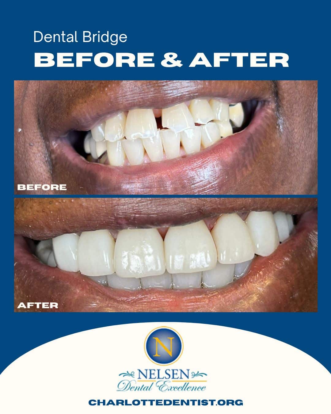 dental bridge befire and after charlotte dentist