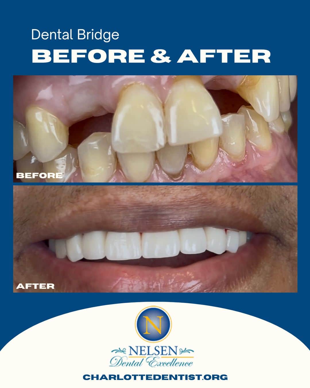 dental bridge befire and after charlotte dentist