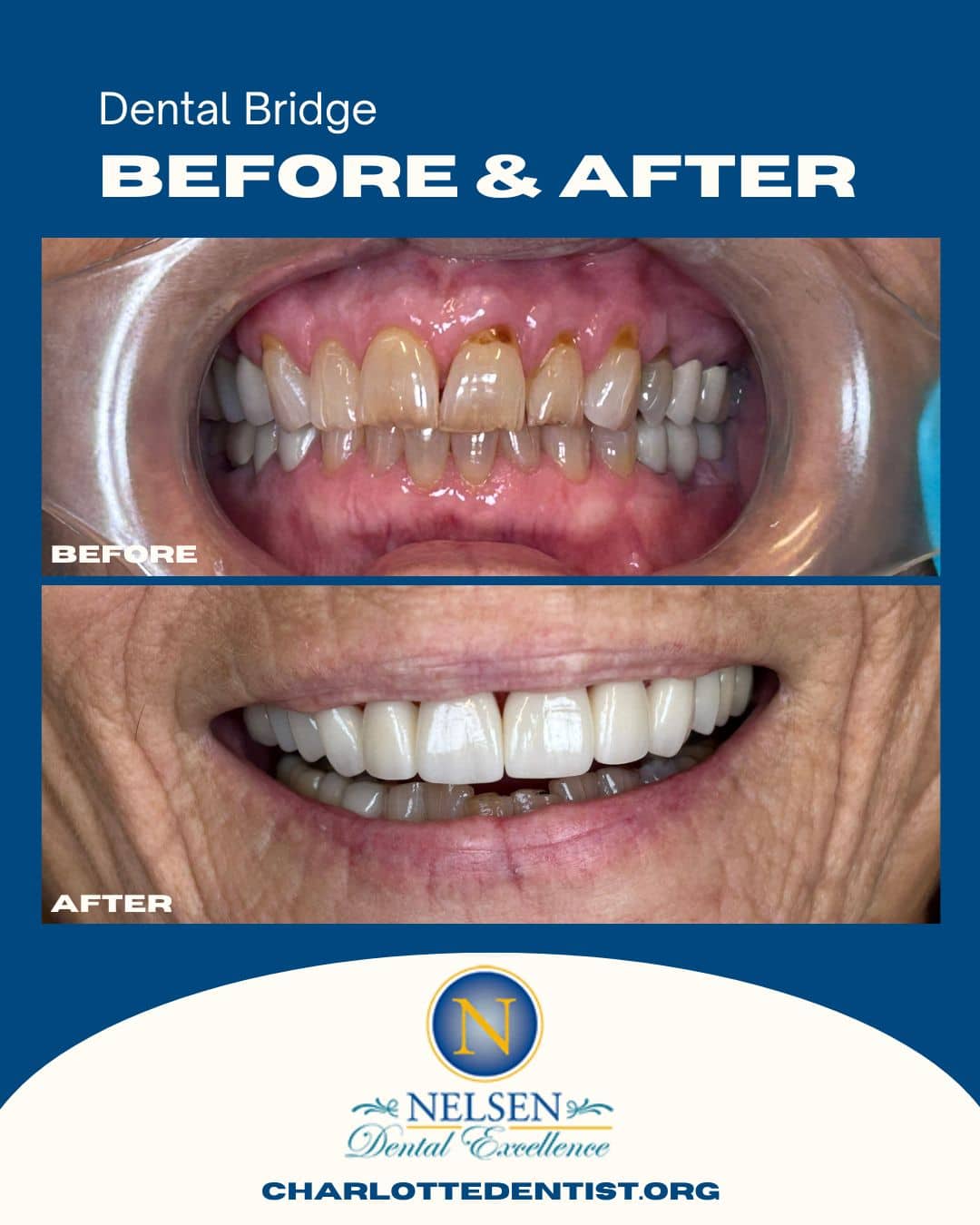 Charlotte Dentist Before and Afters dental bridge