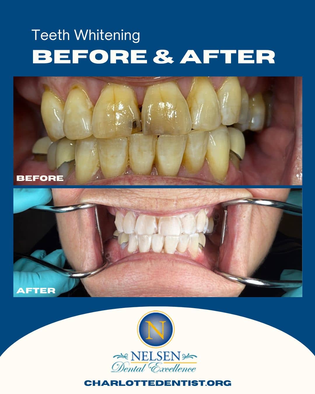 Dr Nelsen Charlotte Dentist Before and Afters teeth whitening