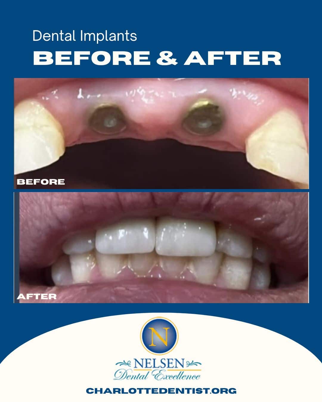 Dental Implants before and after charlotte dentist
