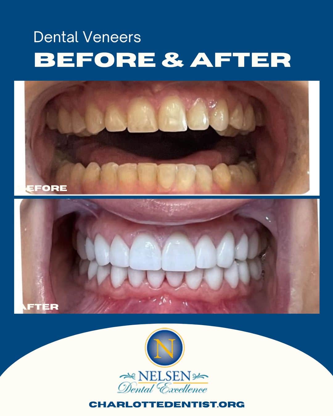 Dental Veneers before and after charlotte dentist