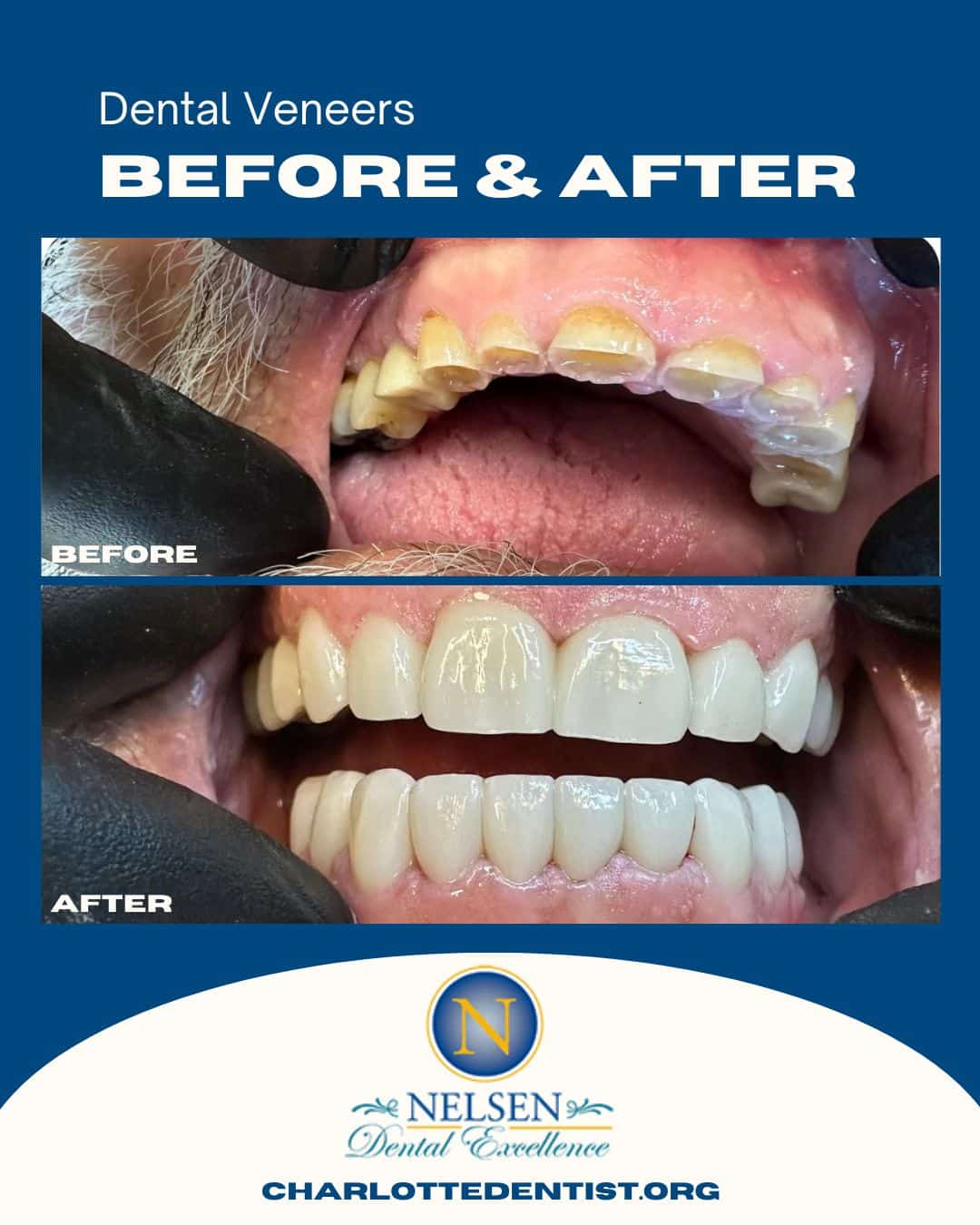 Dental Veneers before and after charlotte dentist