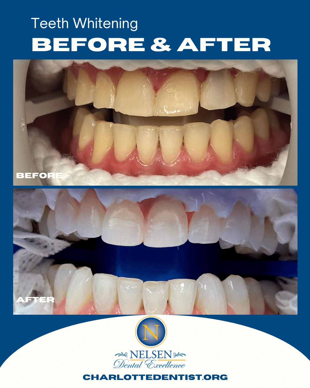 Dr Nelsen Charlotte Dentist Before and Afters teeth whitening