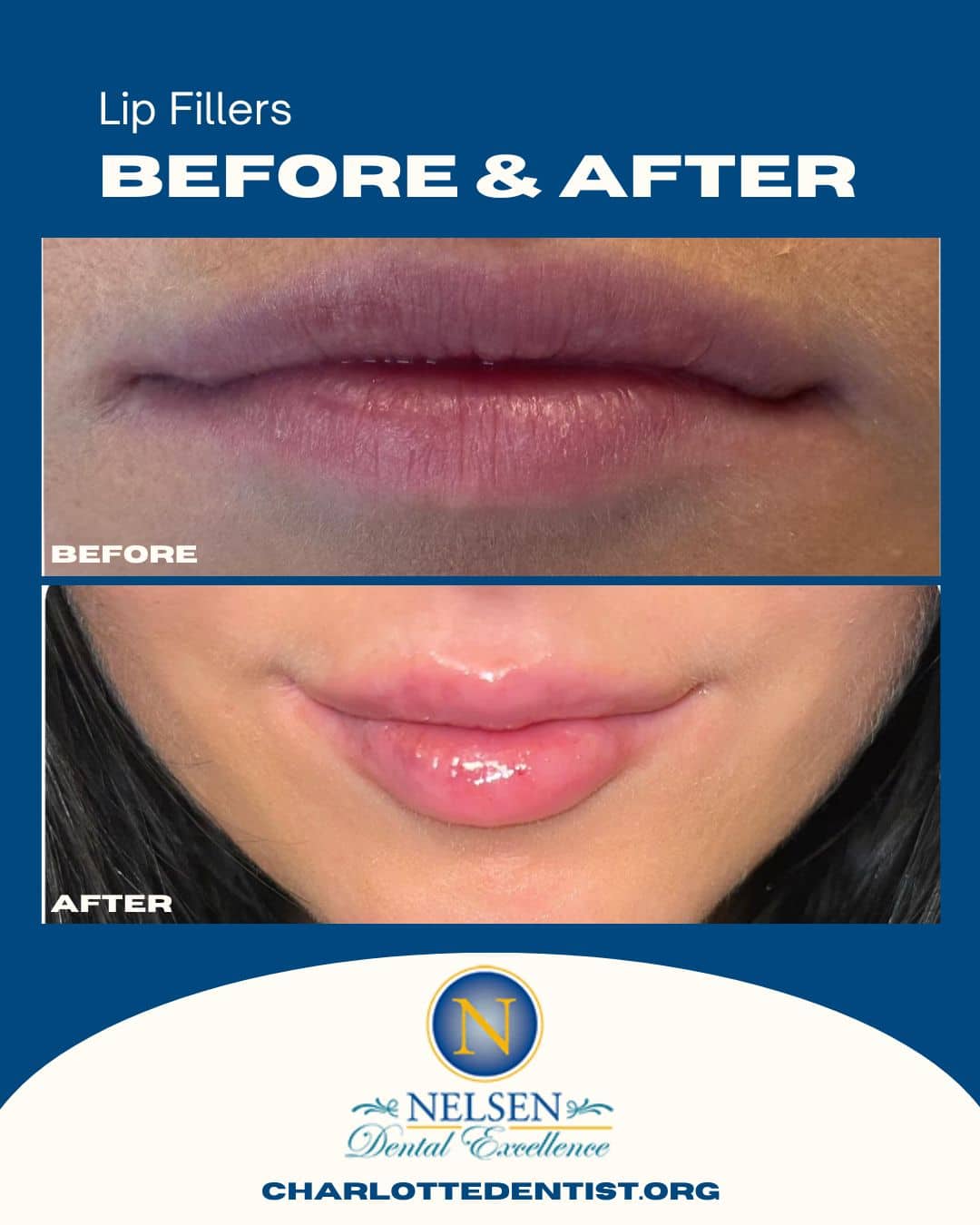Dr Nelsen Charlotte Dentist Before and after lip fillers