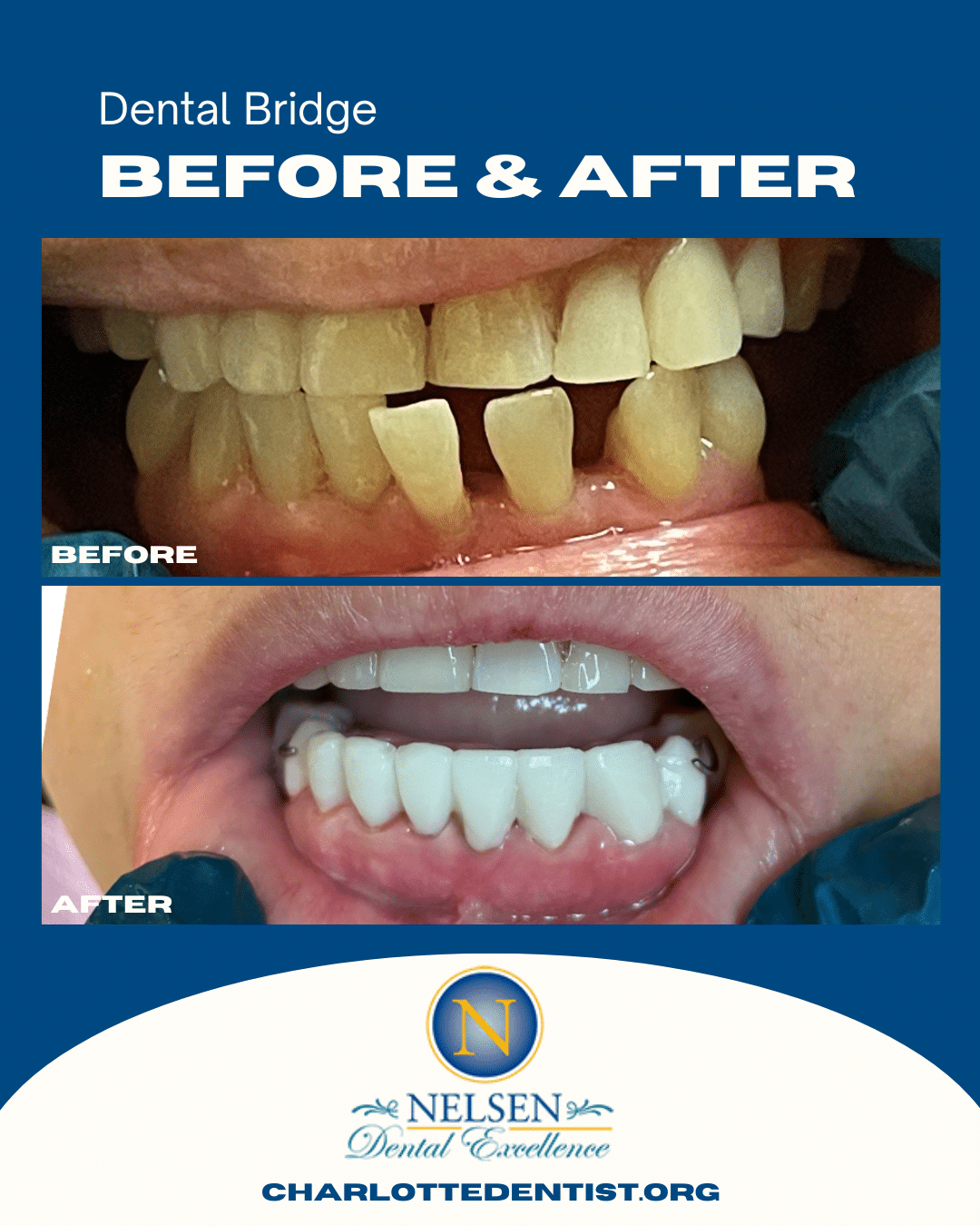 Dr Nelsen Charlotte Dentist Before and Afters dental bridge