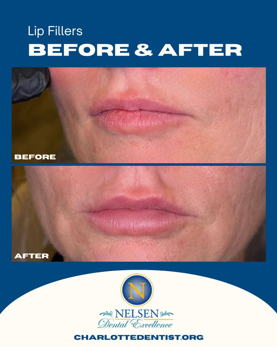 lip fillers charlotte nc