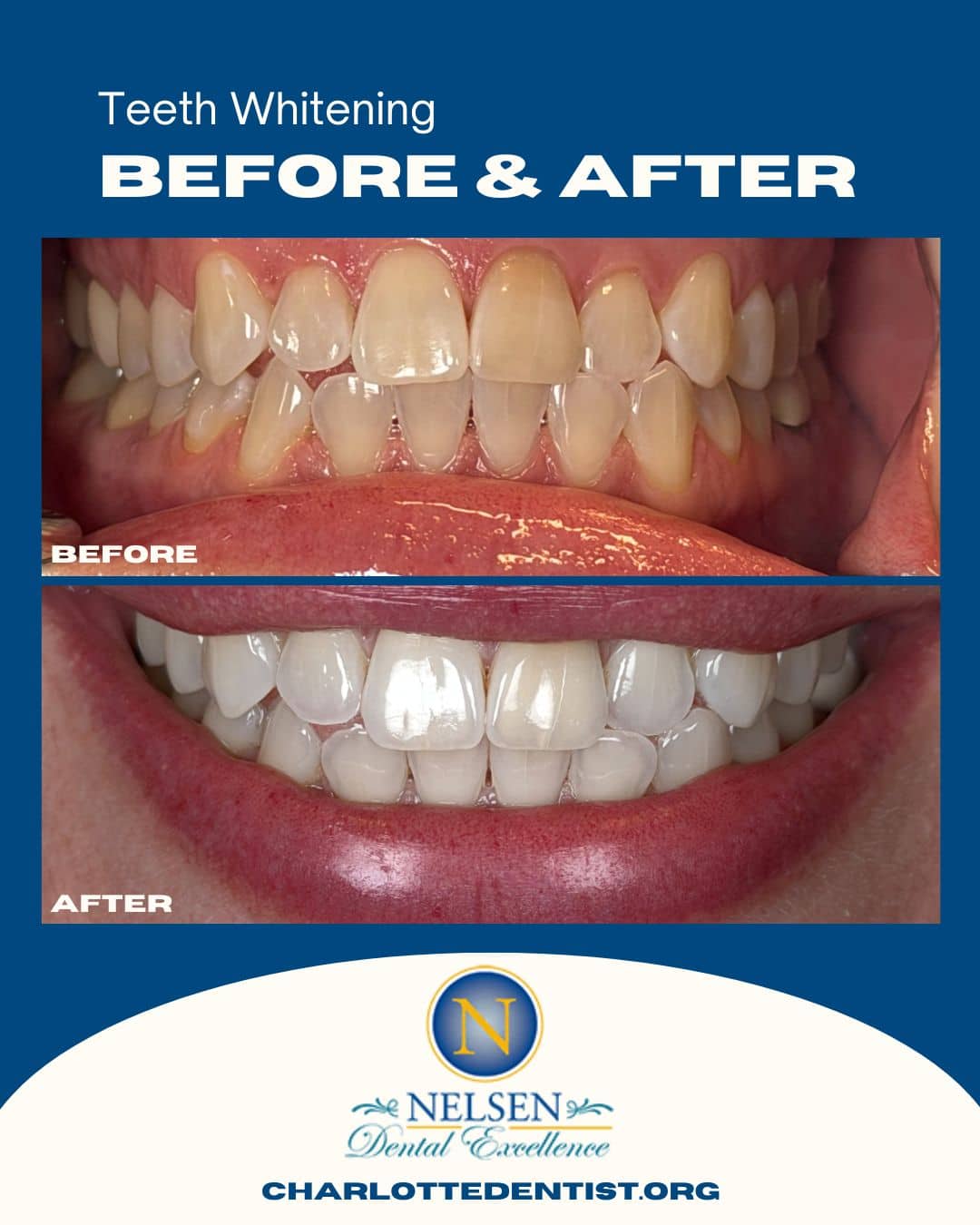 teeth whitening dentist charlotte